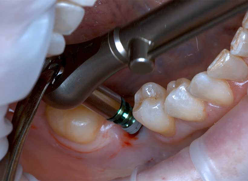 Osstem-46-Flapless-01 Osstem-46-Flapless-01